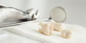 What to Eat After a Tooth Extraction: Your Recovery Food Guide