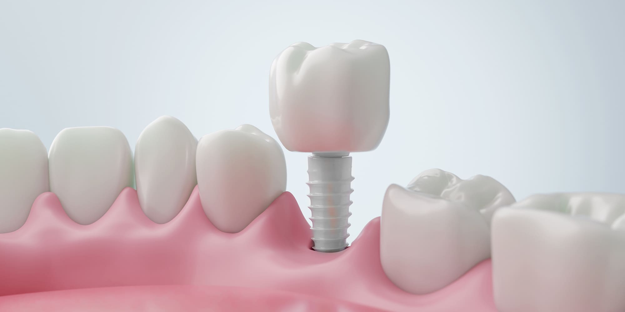 Zirconia Dental Implants: A Metal-Free Solution for Lasting Smiles