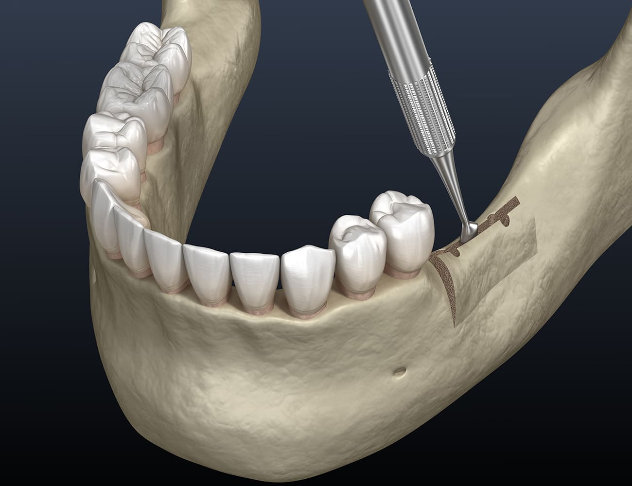 Lower Ridge Augmentation Ridge Augmentation Seattle WA | Green Lake Oral & Facial Surgery