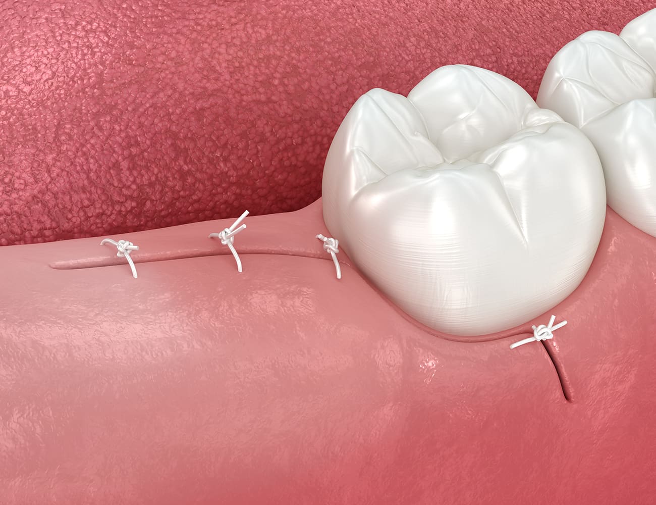 Wisdom Teeth Removal