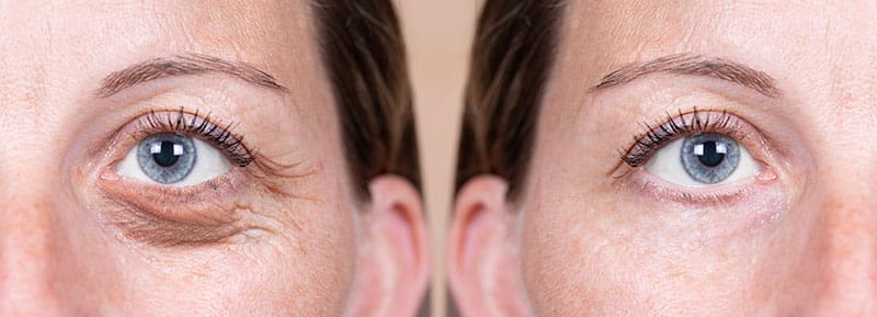 Single and Double Eyelid surgery