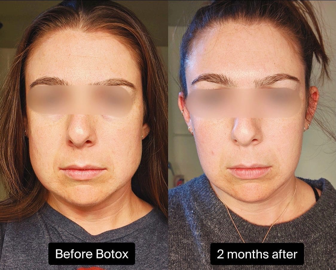 Submental liposuction surgery