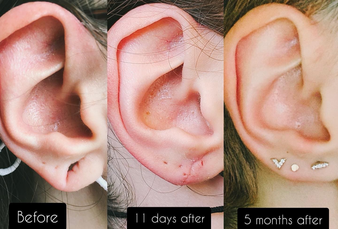 Earlobe repair before & after