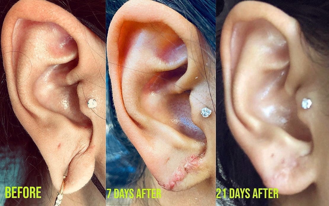 Earlobe repair before & after