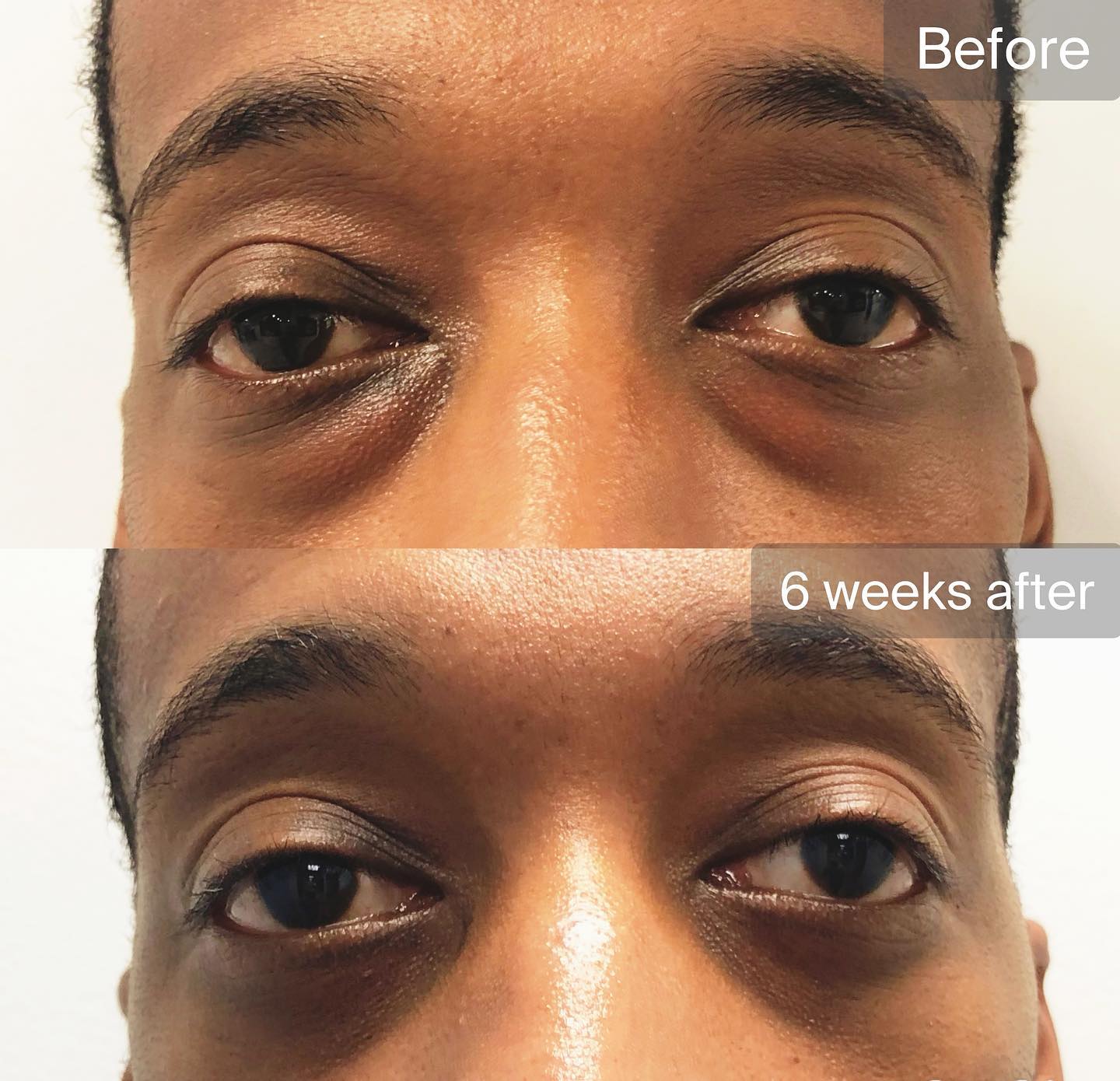 Lower Blepharoplasty surgery before and after