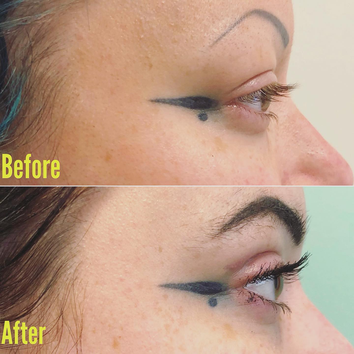 Upper Blepharoplasty surgery 11 weeks apart