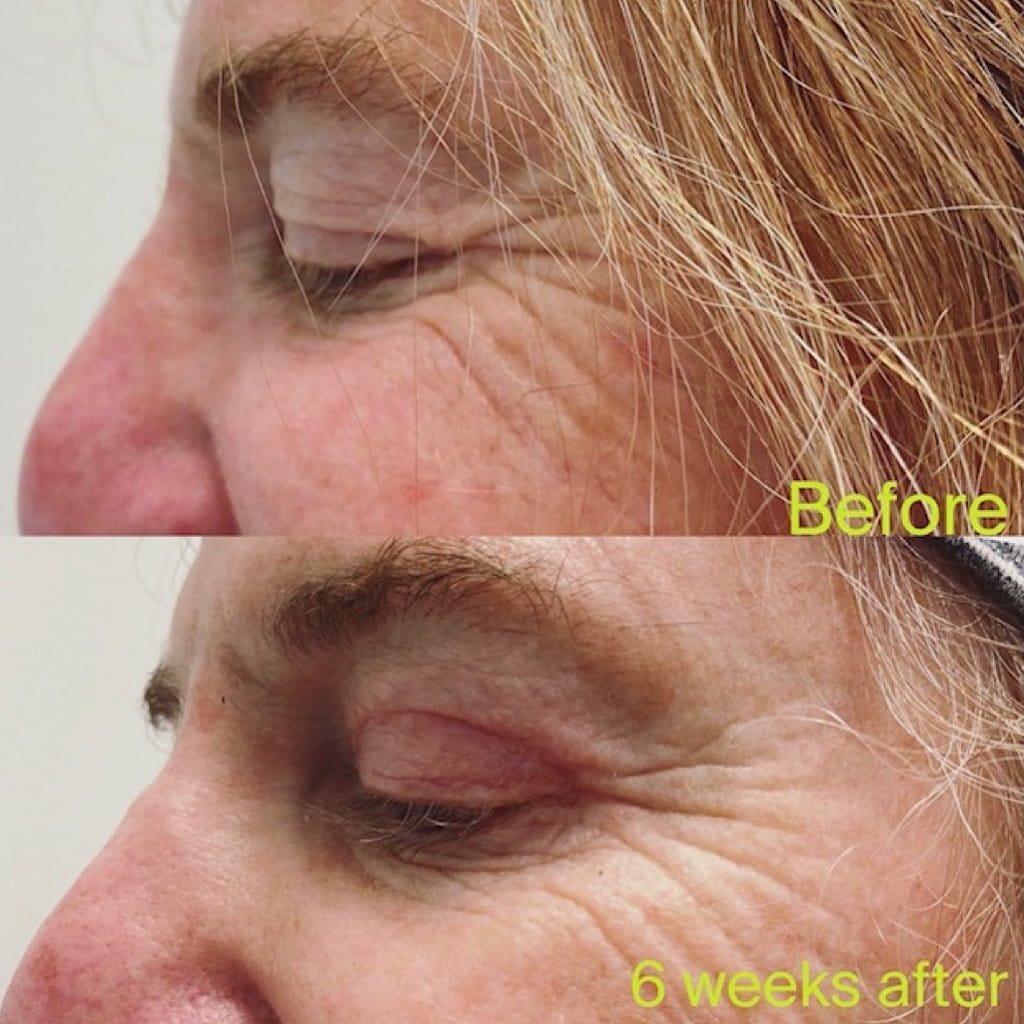 Upper Blepharoplasty surgery 6 week checkup
