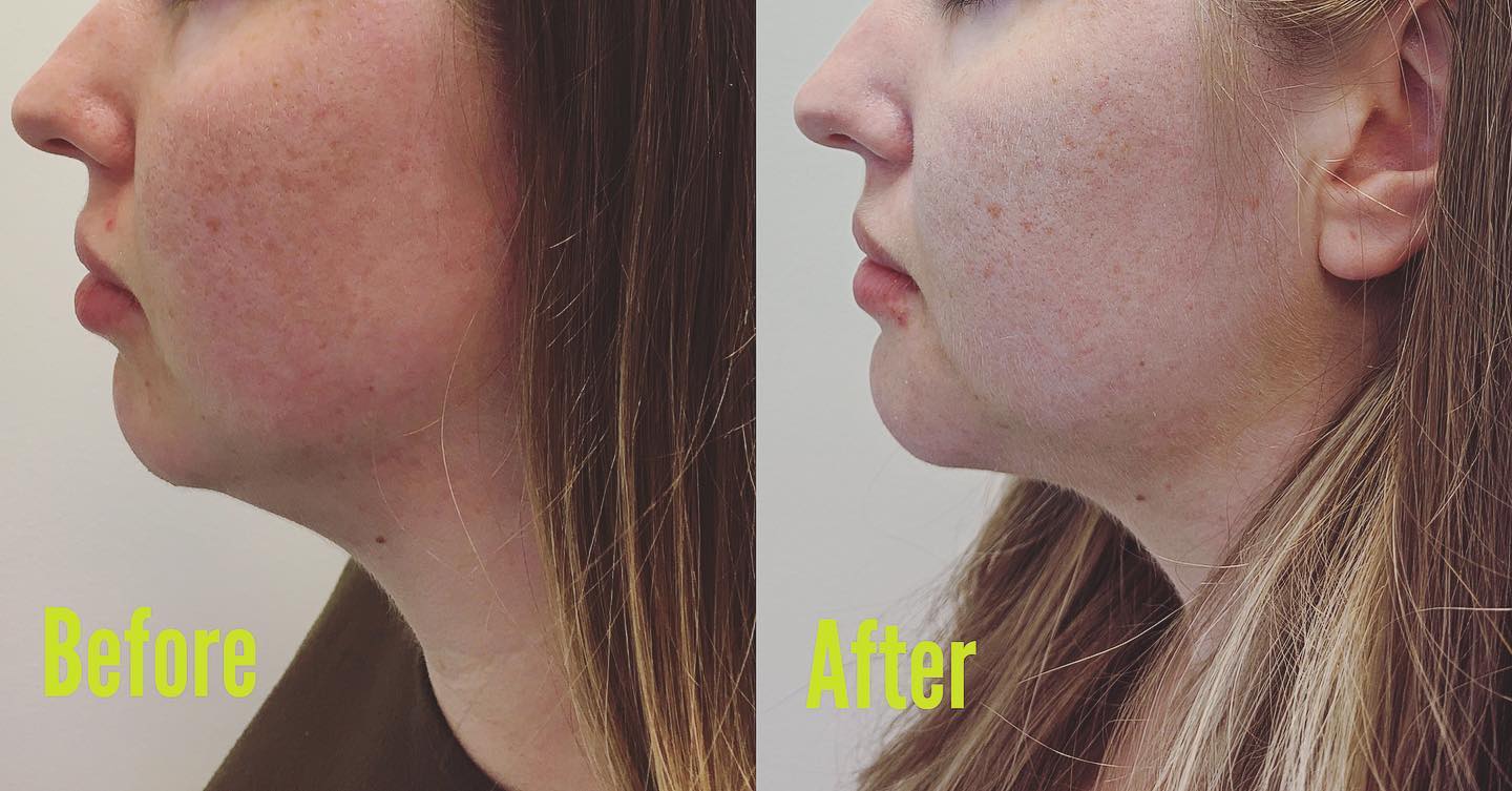 Submental liposuction surgery