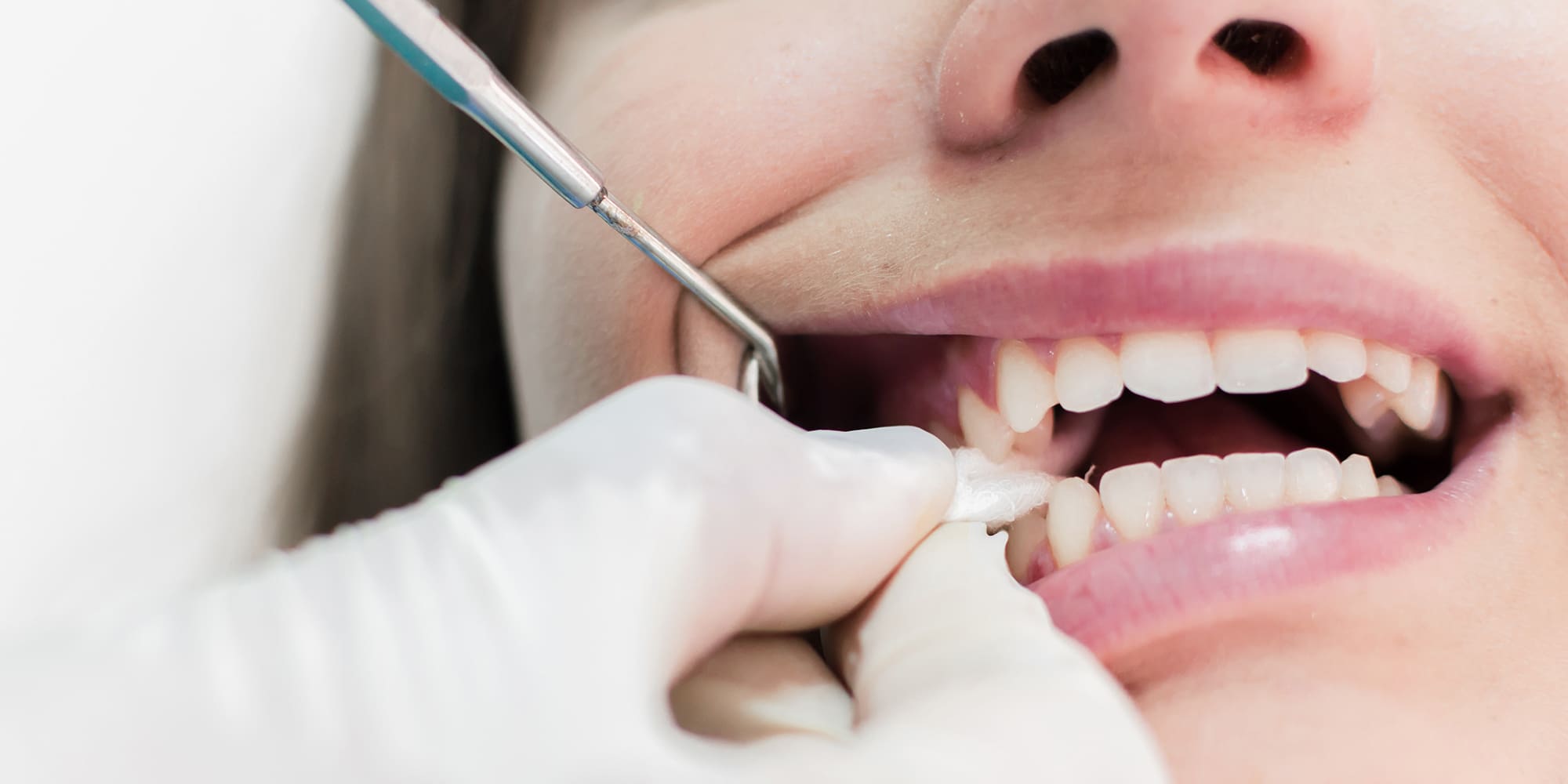 When To Stop Using Gauze After a Tooth Extraction