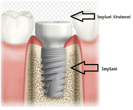 Implant Abutment